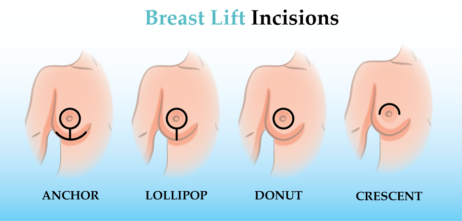 Breast Lift